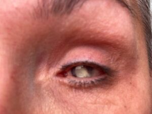 Foto van Debby’s linkeroog, waarvan de pupil grijs is, doordat er veel littekenweefsel in het oog zit.